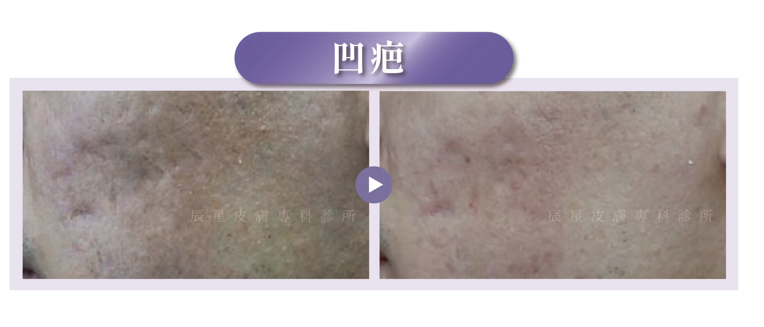 玻尿酸注射、玻尿酸功效、玻尿酸材質、玻尿酸用途、玻尿酸填充、玻尿酸選擇、玻尿酸術後