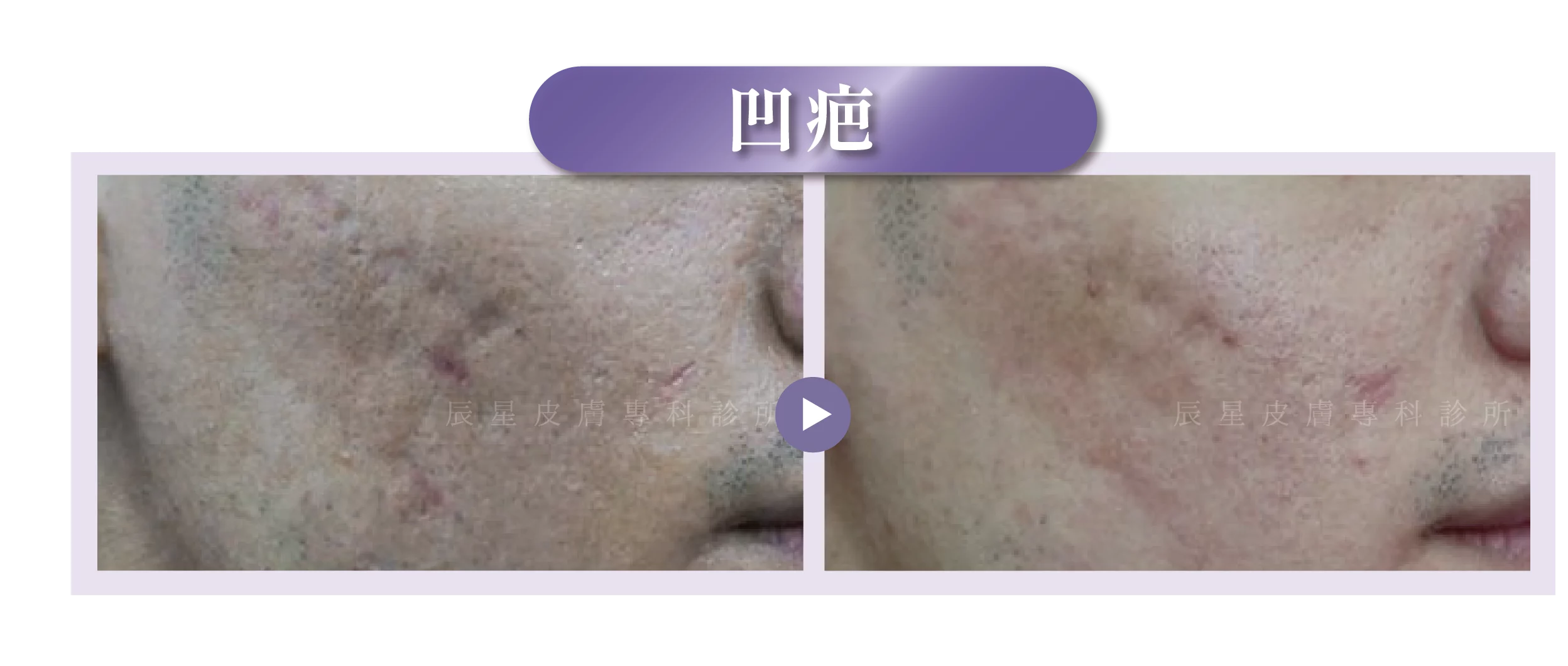 玻尿酸注射、玻尿酸功效、玻尿酸材質、玻尿酸用途、玻尿酸填充、玻尿酸選擇、玻尿酸術後