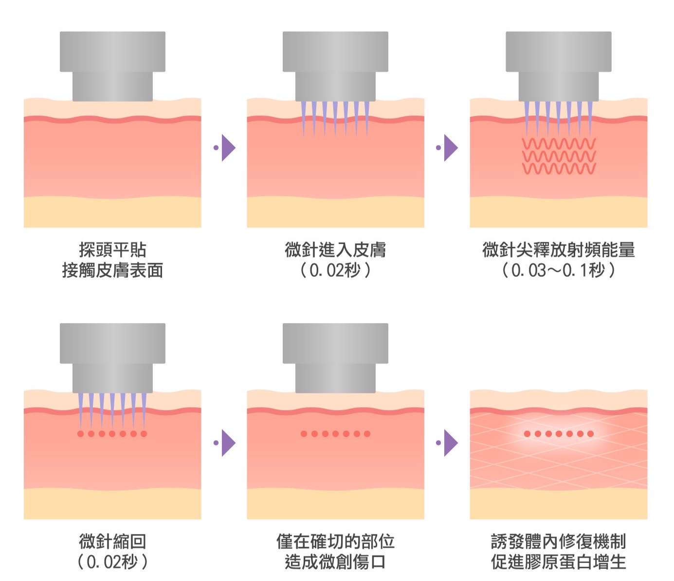 微針電波原理