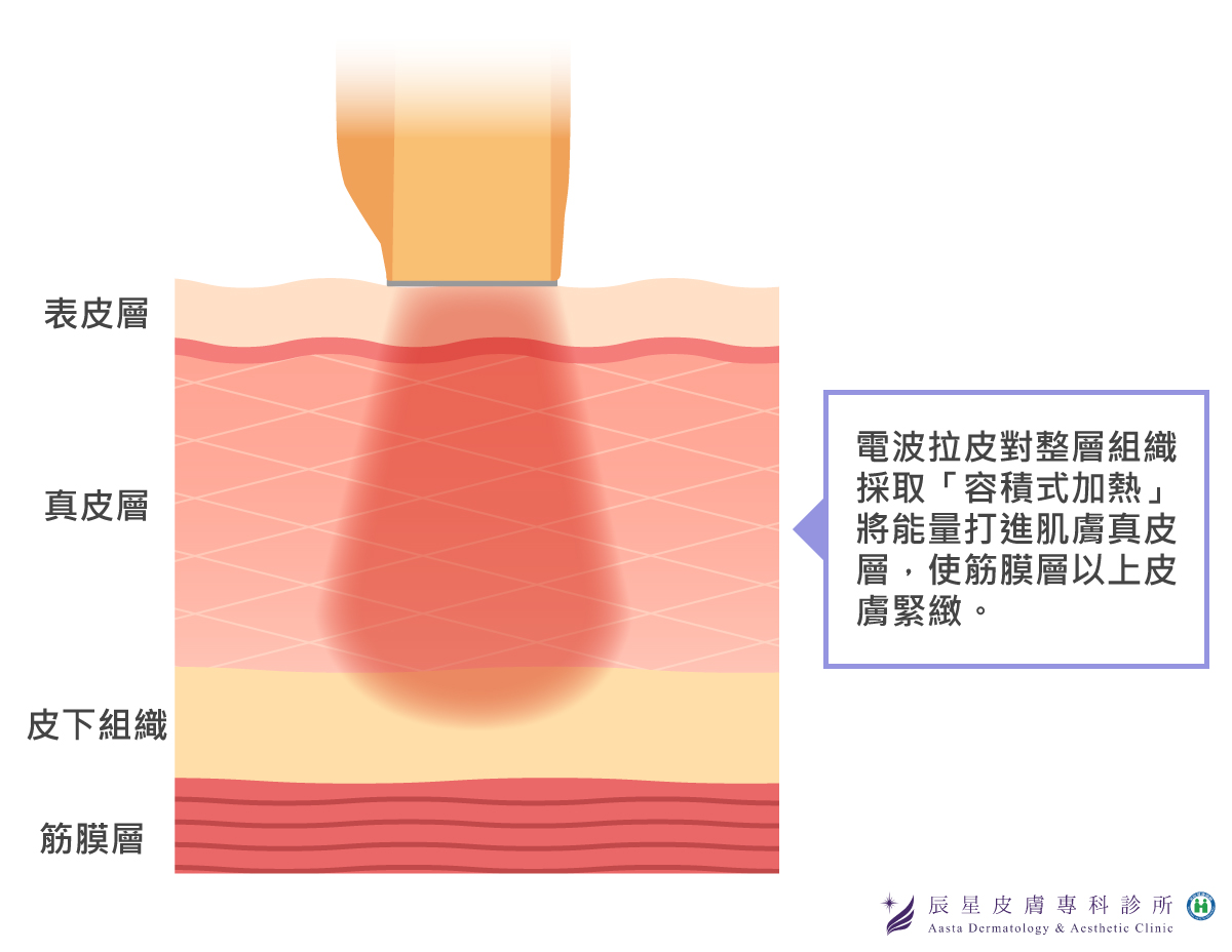 電波拉皮為容積式加熱，使筋膜層以上皮膚緊緻