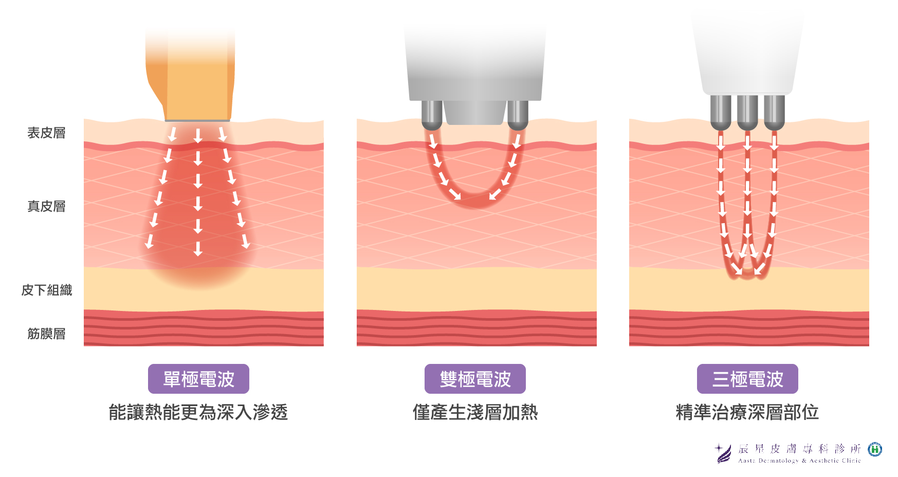 【電波拉皮價格】電波拉皮價格越貴越有效果? 微針電波價格翻轉你的認知! - 辰星皮膚專科診所