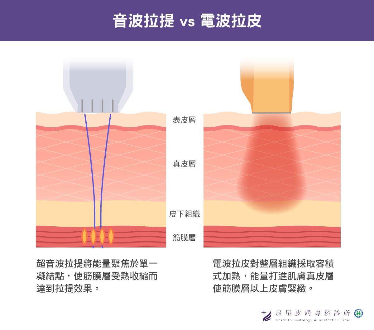 音波拉提與電波拉皮兩種療程的差異，由圖片可看出兩者最大的差別在於加熱方式不同。