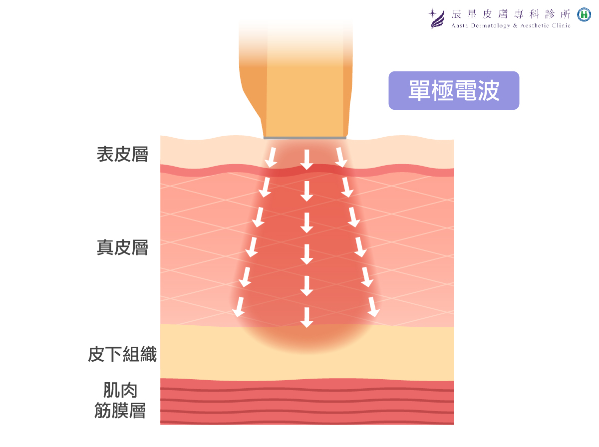 單極電波加熱原理極.單極電波加熱層次