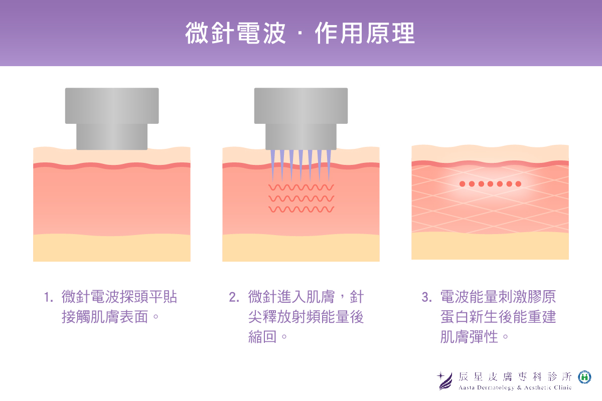 雙下巴醫美-微針電波作用原理