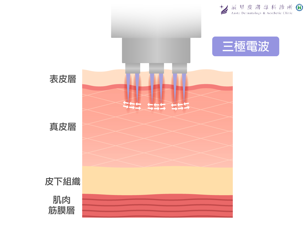 微針電波屬於多極電波，微針電波的治療原理，是利用一個治療點上同時有多個電極，互相通以電流與皮膚接觸