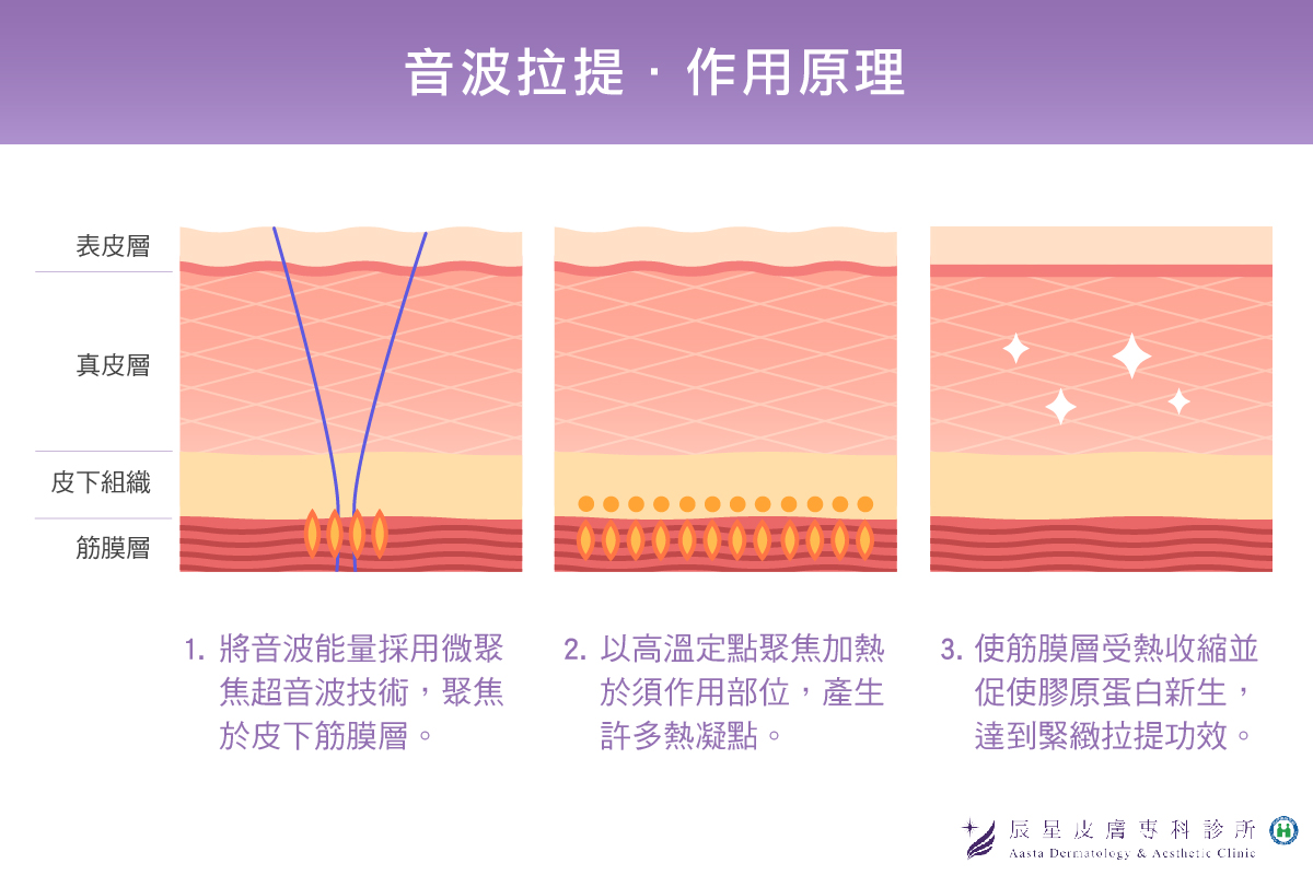 雙下巴醫美-音波拉提作用原理