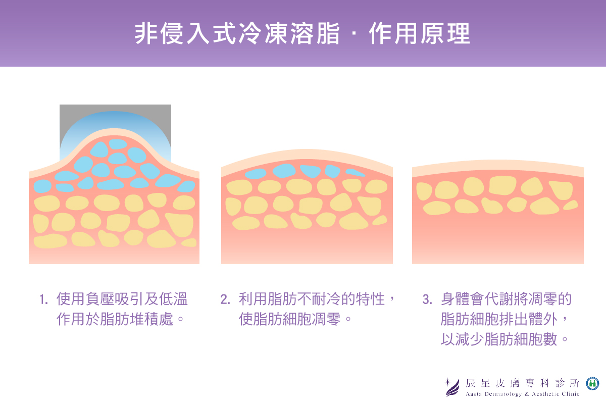 雙下巴醫美-非侵入式冷凍溶脂作用原理