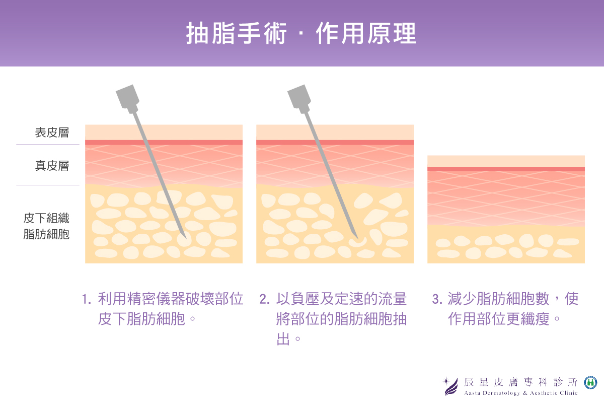 雙下巴醫美-抽脂手術作用原理