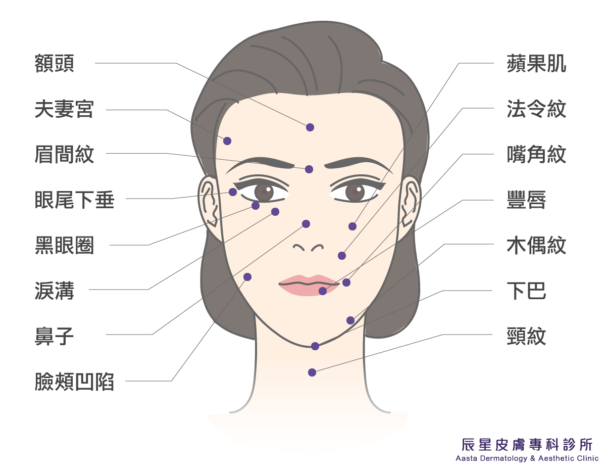 玻尿酸適用部位