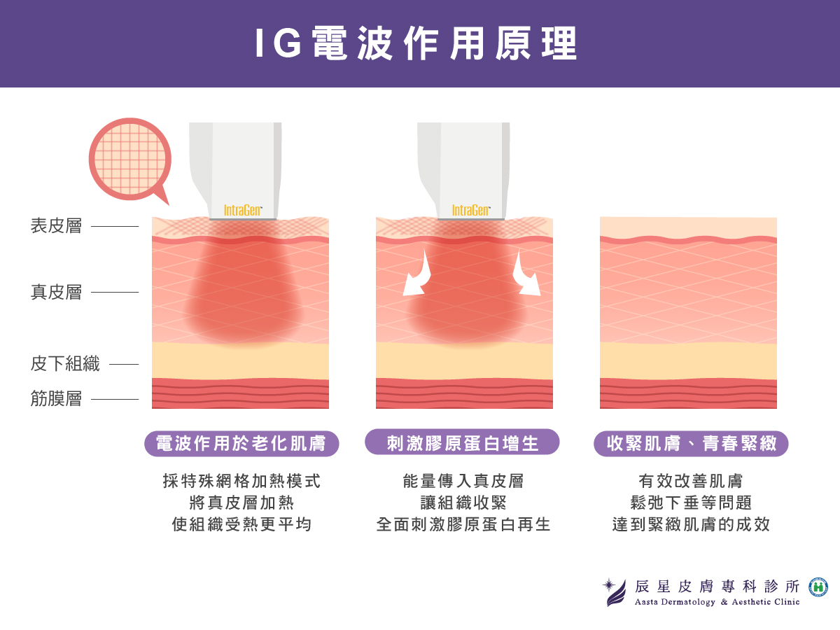 IG電波作用原理