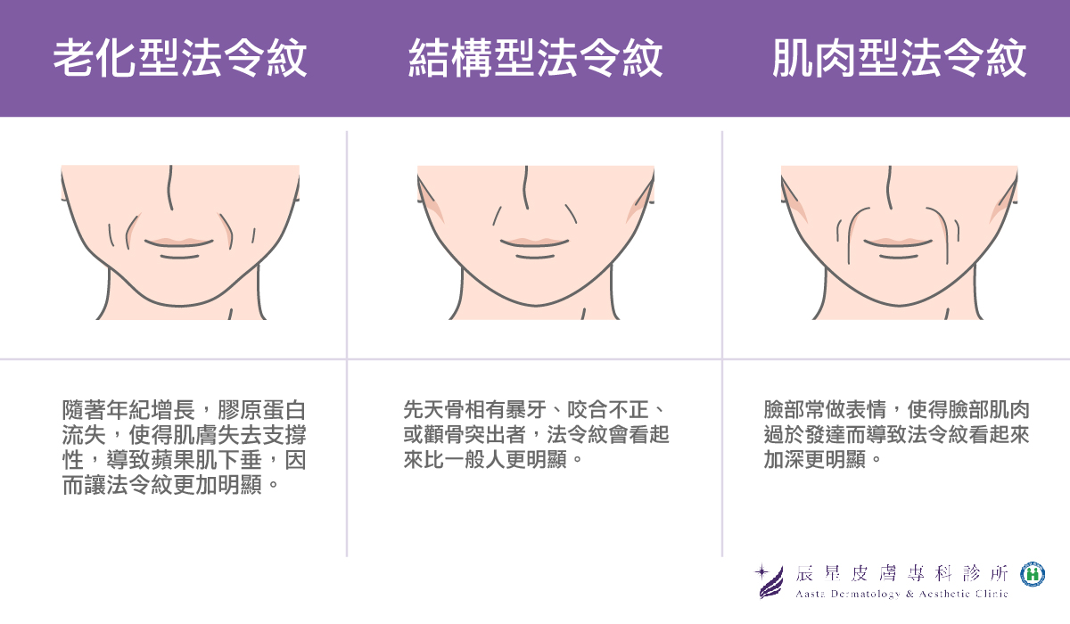 各種不同類型的法令紋