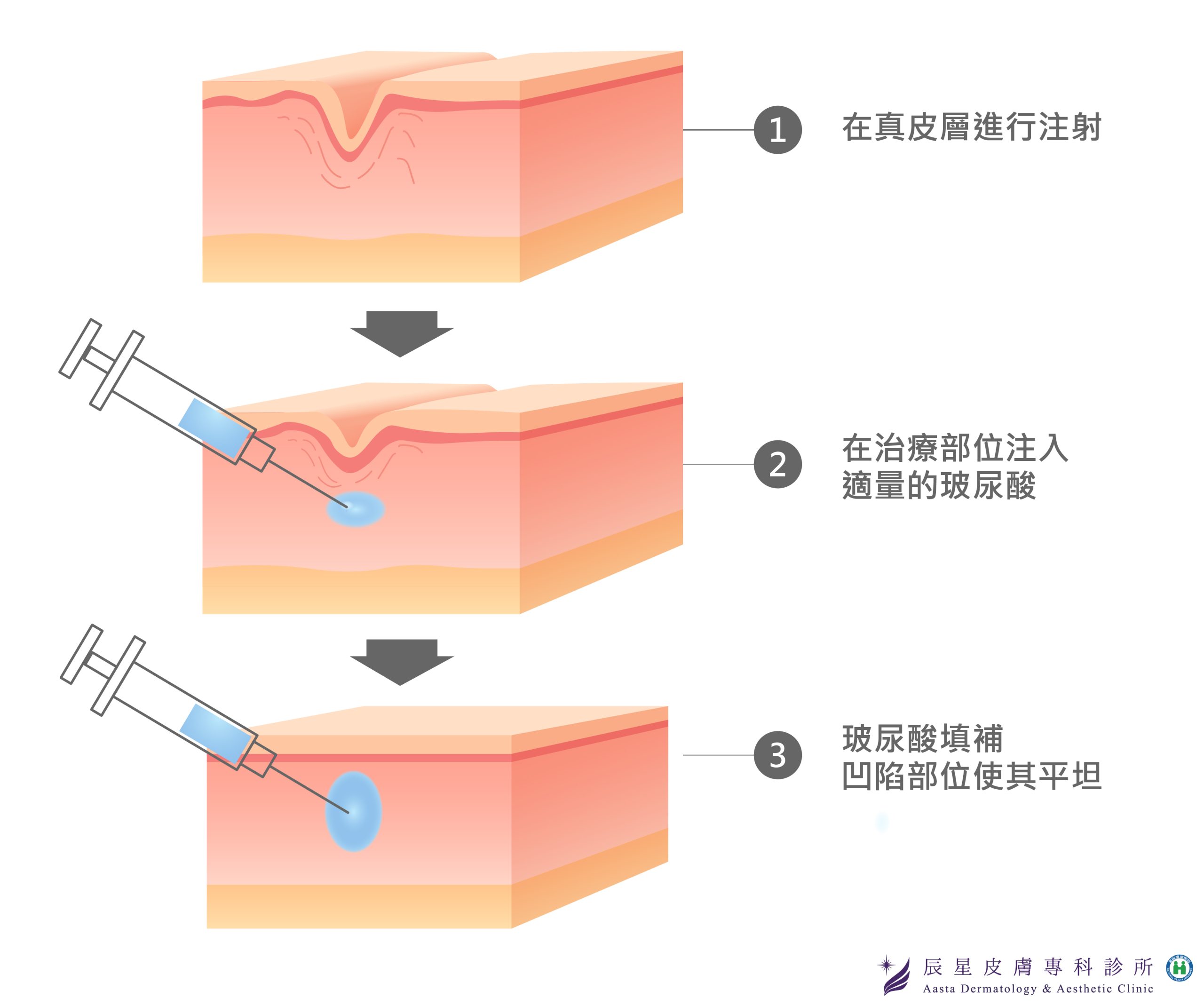 玻尿酸法令紋效果