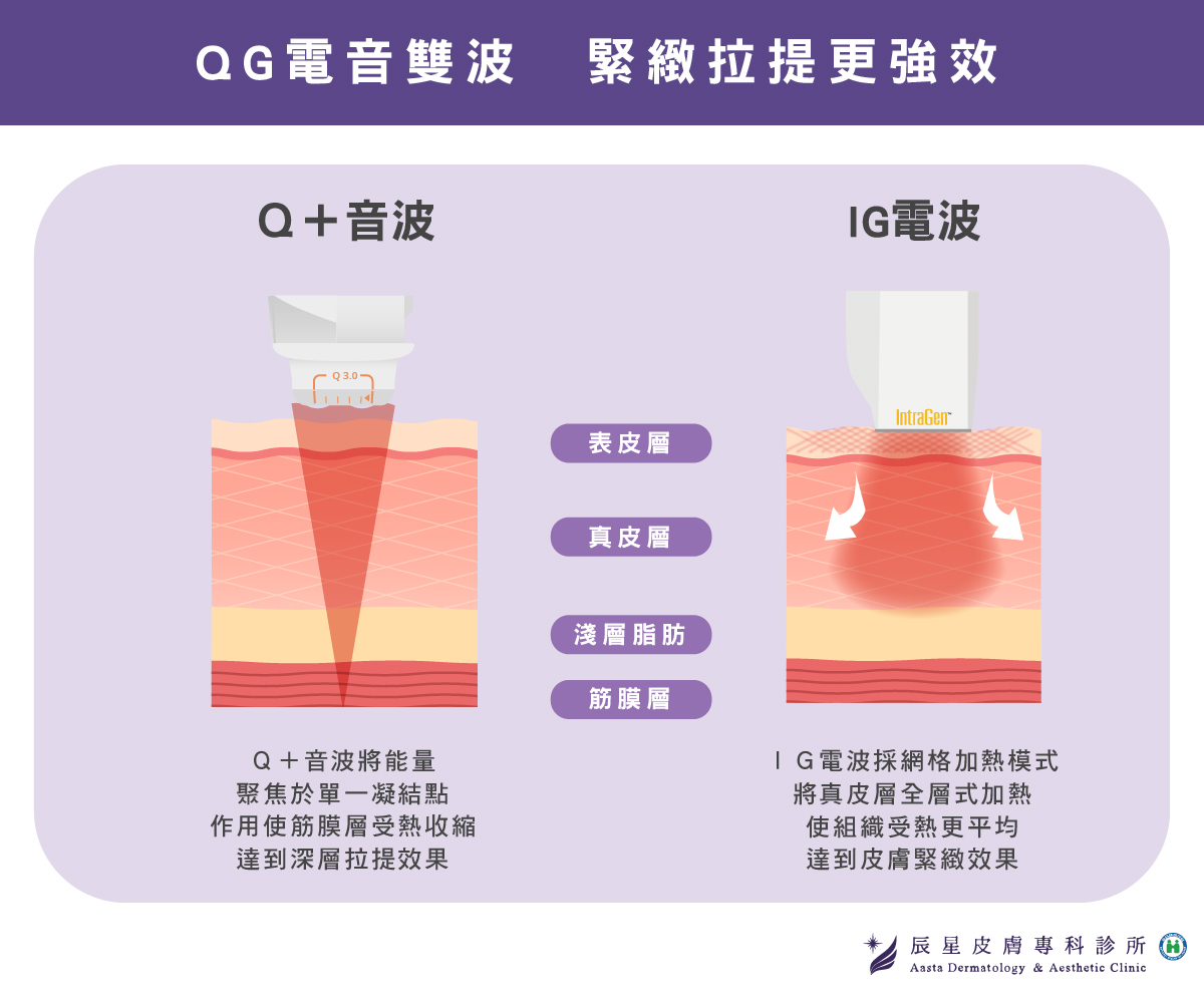 辰星電音雙波-Q+音波結合IG電波-緊緻拉提