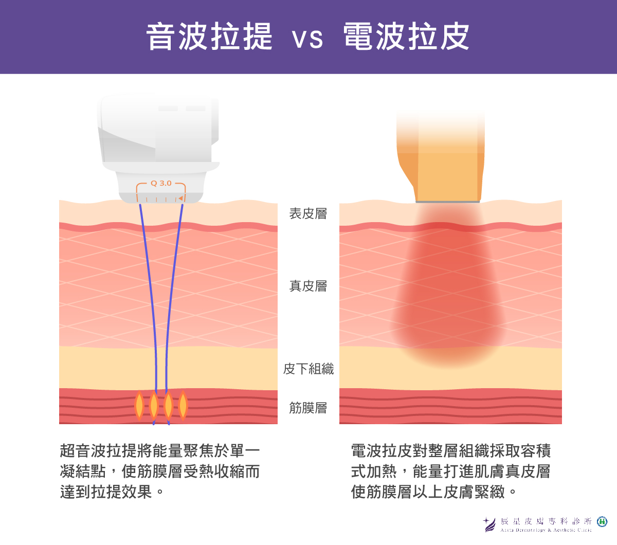 電波音波透過熱能堆疊緊實V臉效果