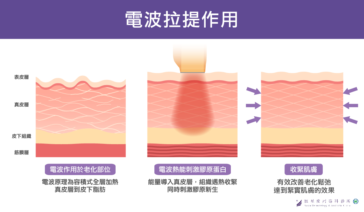 【電音雙波效果】-電波拉皮效果:緊實