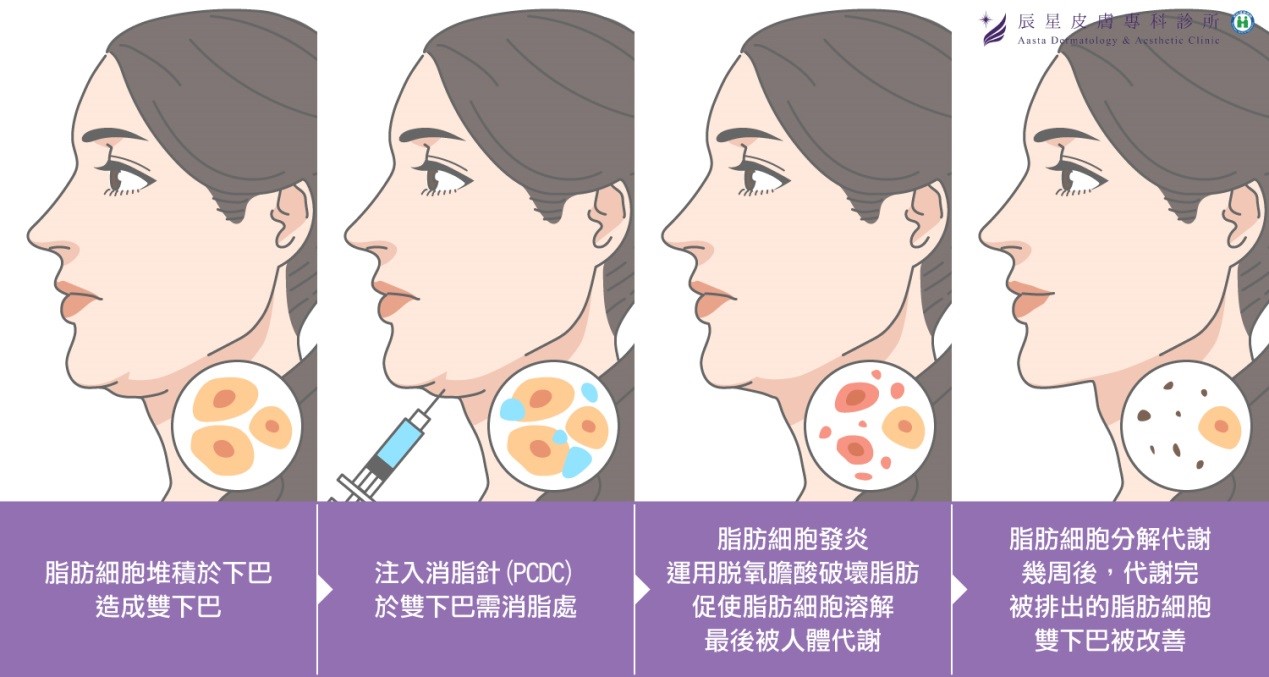 消脂針治療脂肪已經正式通過美國FDA，接受治療的患者也有極高的滿意度。除了雙下巴，在國外廣泛運用於，如臉頰、脖子、蝴蝶袖、腹部、臀部、大腿、小腿等局部肥胖部位