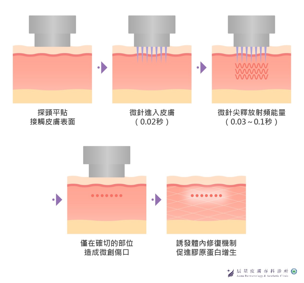 微針電波治療雙下巴是透過極細小的微針，藉由皮下熱能傳導刺激真皮層膠原蛋白新生