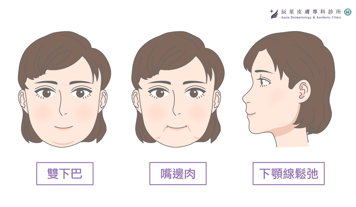 3種臉部鬆弛情況