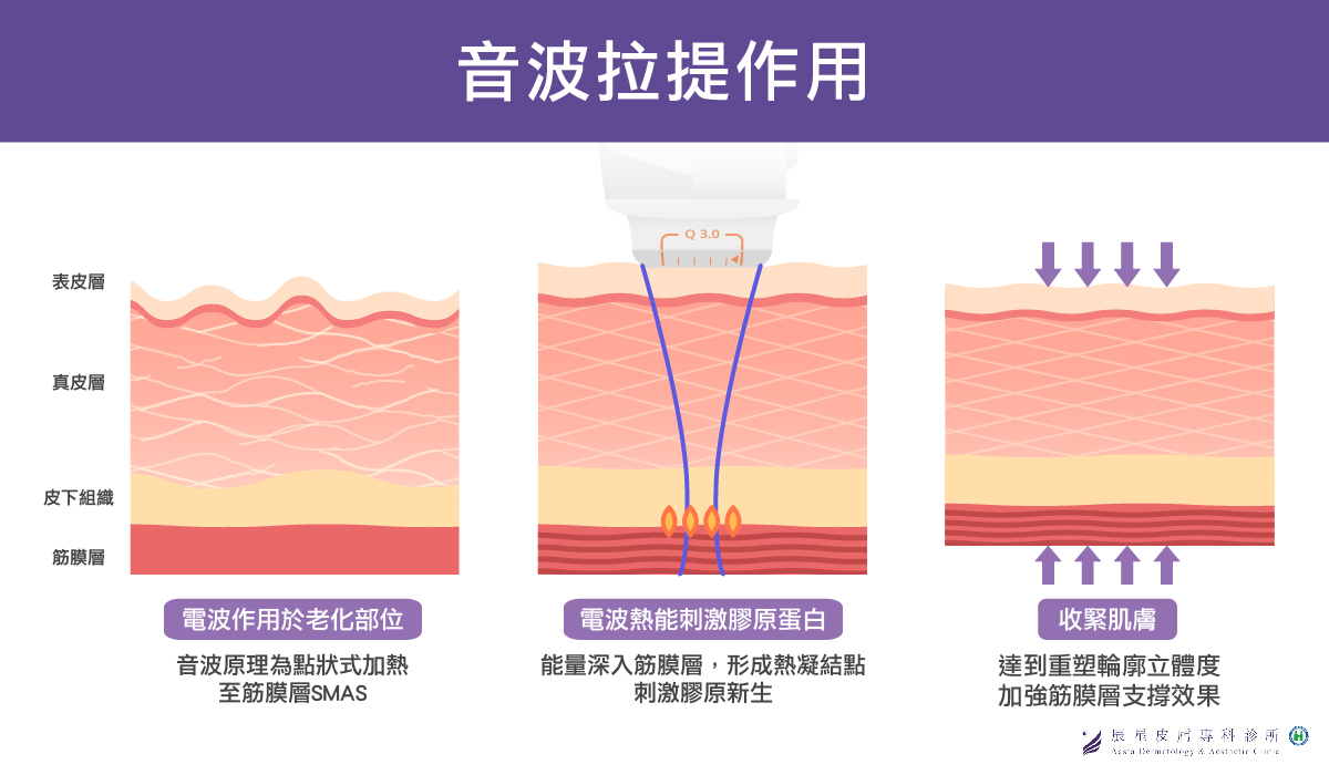 抗老拉皮選擇２：音波拉提