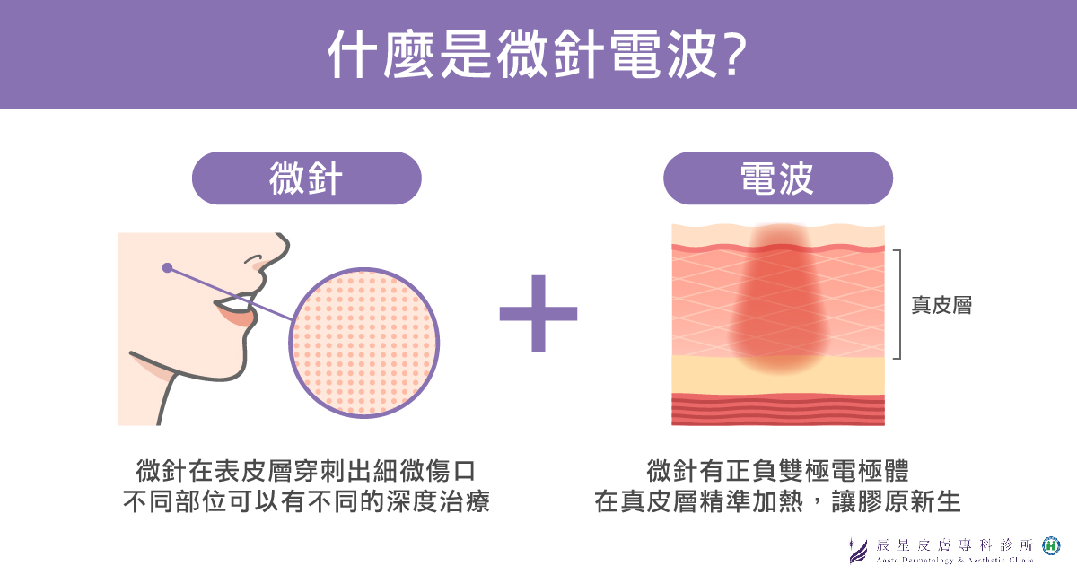 年底保養期將近，打微針電波效果好嗎？