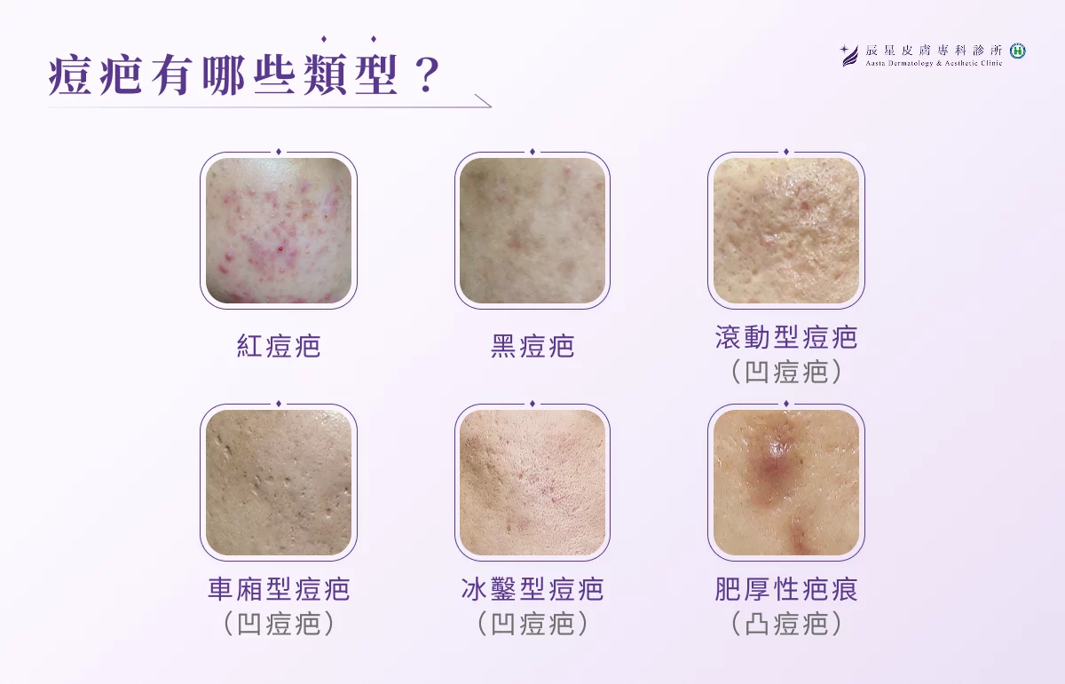 痘疤有哪些類型？