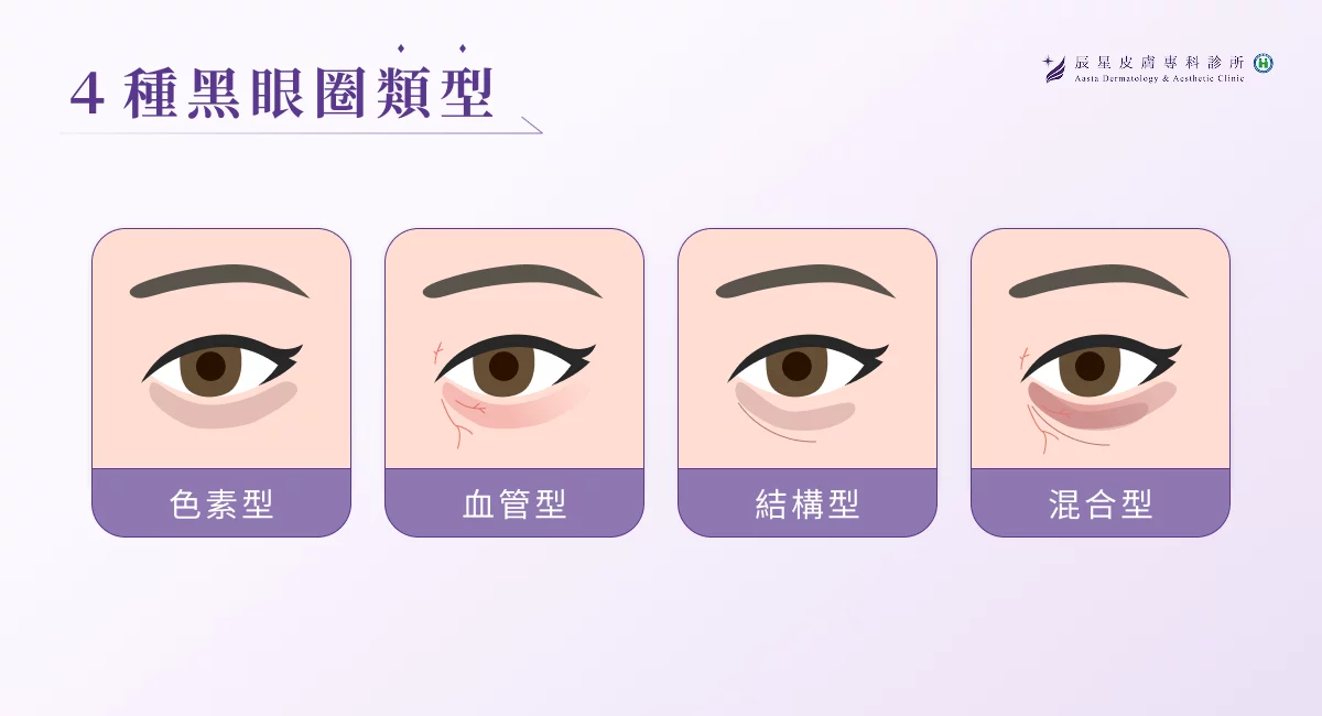 4 種黑眼圈類型