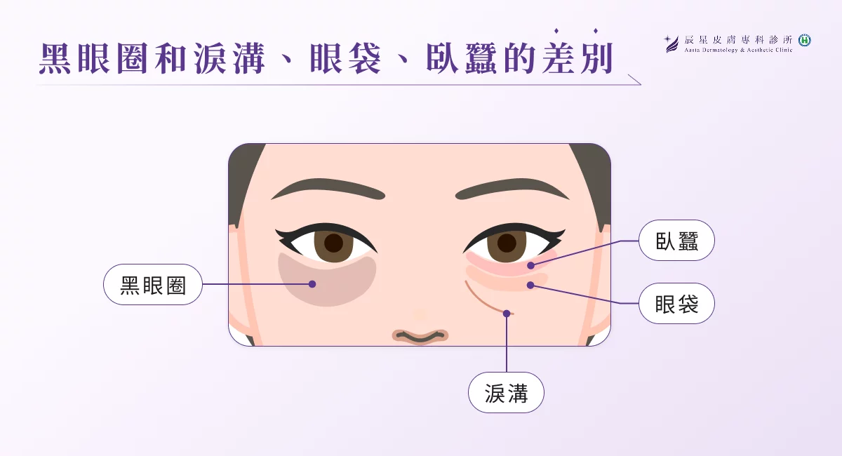 黑眼圈和淚溝、眼袋、臥蠶的差別
