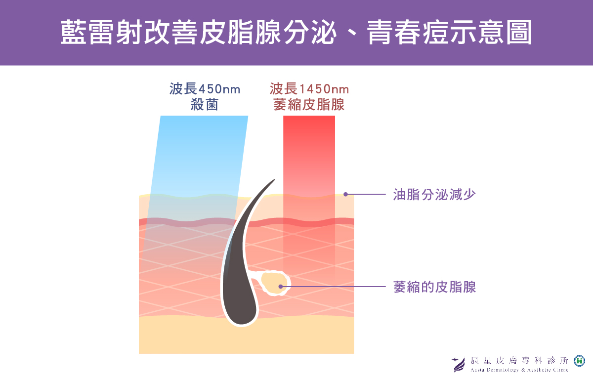 辰星藍雷射抗痘療程