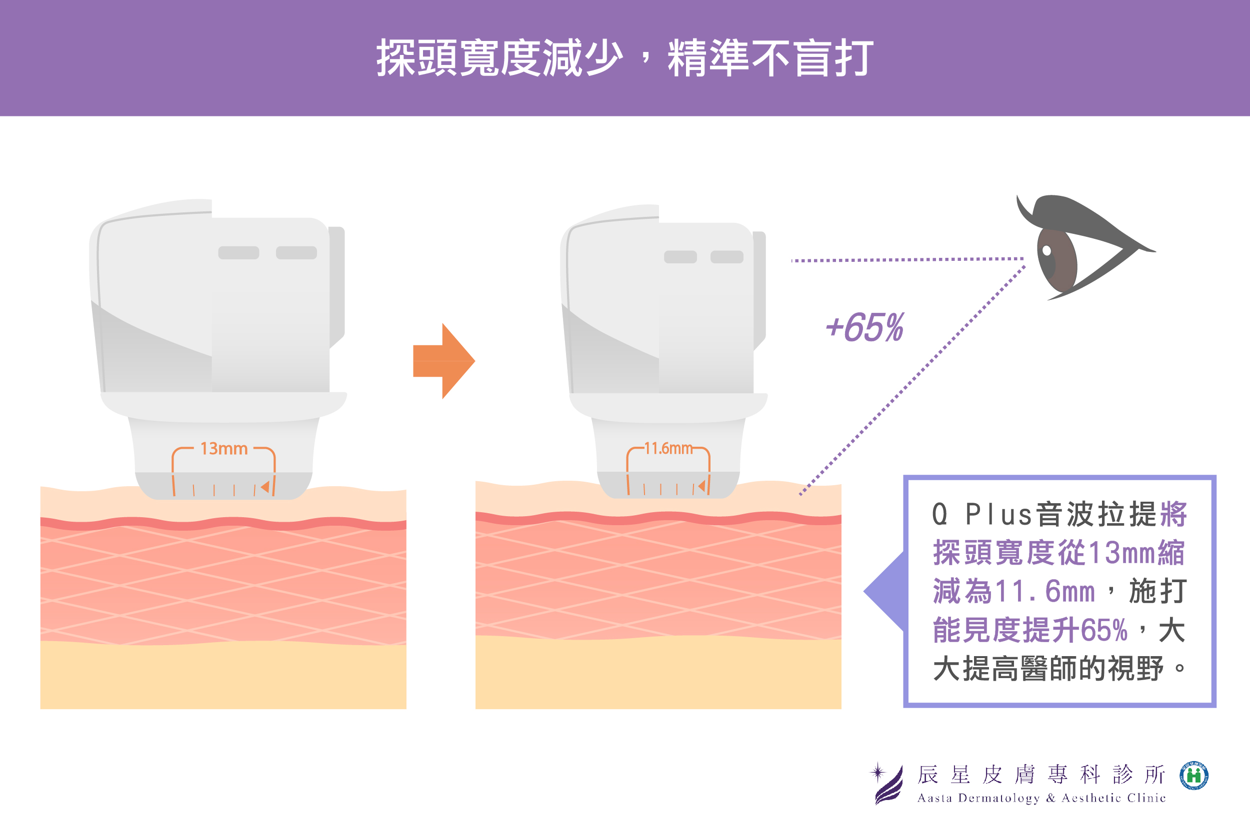 新一代Q+立線音波拉提最大的優勢，除了擁有更全面性的線性探頭，還有另一個特點是：「探頭寬度減少，能見度提升65%，大幅增加醫師視野！」且探頭更可以完整服貼精準治療狹窄部位，提升療程細緻度！