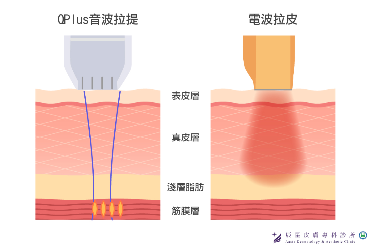 電波拉皮的作用對筋膜層以上的全層真皮層肌膚組織，進行大範圍容積式加熱；而線性音波Q+則是深入SMAS筋膜層收緊。