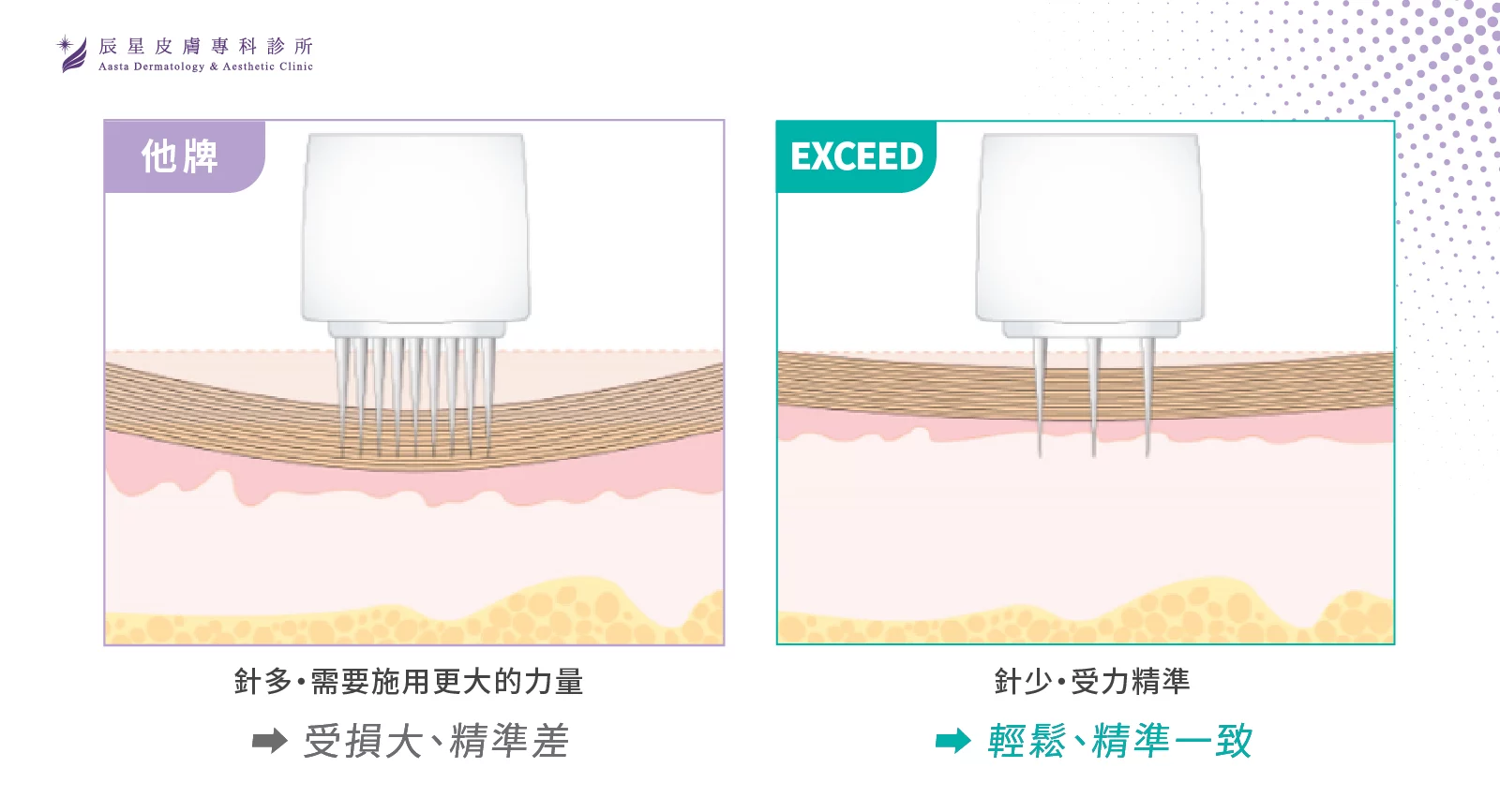 exceed 愛美微針、愛美微針、微針效果、毛孔粗大、眼下 細紋、細紋、毛孔、凹洞、電動微針、滾針、滾針醫美、微 針療程價格、微針、微針精華、微針滾輪、水光針