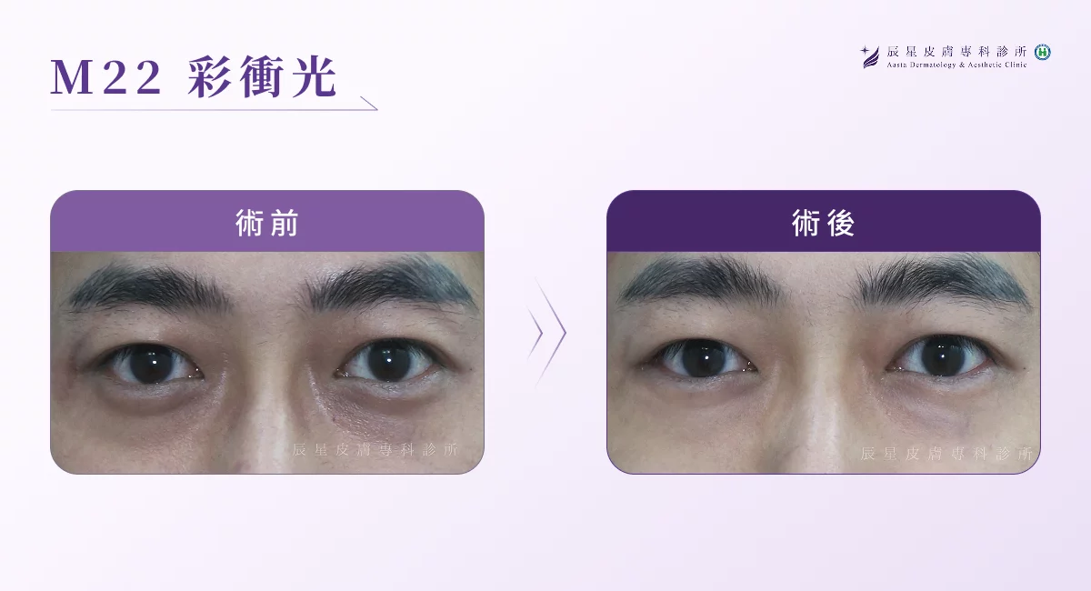 黑眼圈醫美 M22 彩衝光