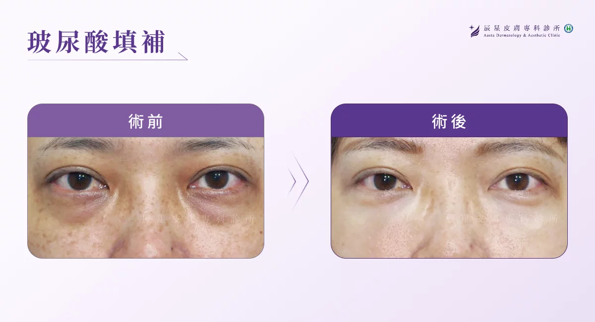 黑眼圈醫美 玻尿酸填補
