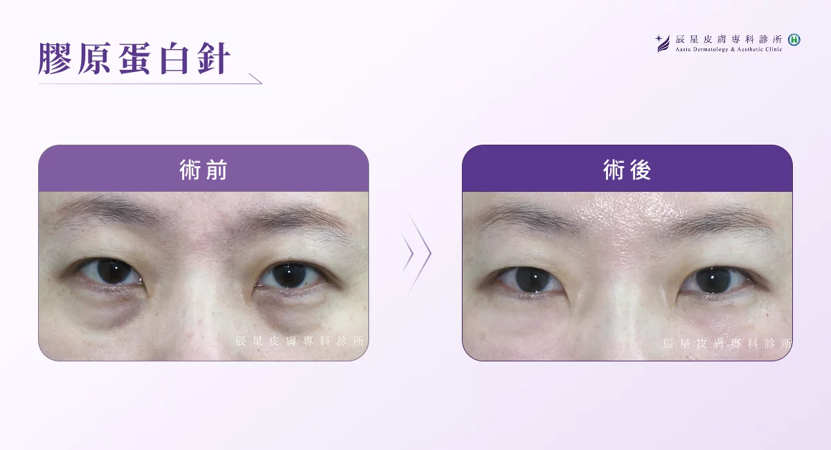 黑眼圈醫美 M22 彩衝光＋膠原蛋白針 -1