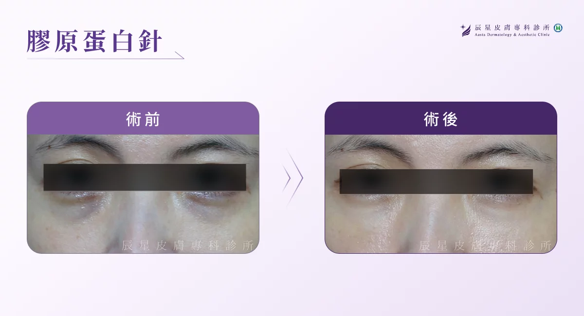 黑眼圈醫美 M22 彩衝光＋膠原蛋白針 -2