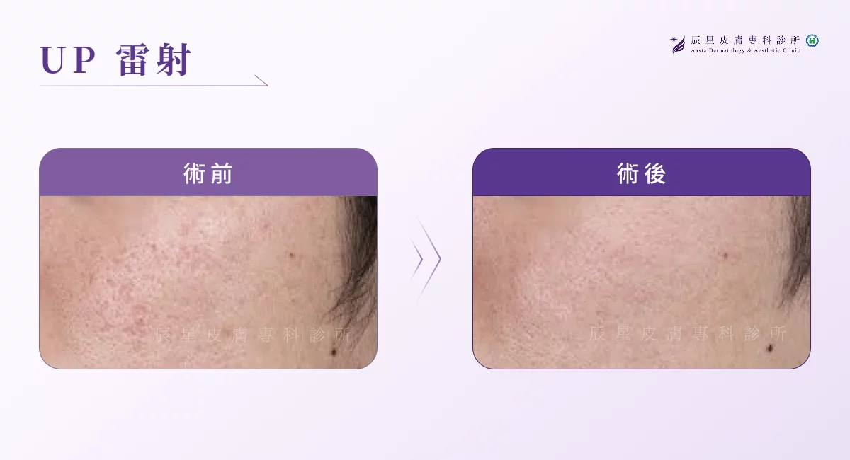痘疤雷射 UP 雷射