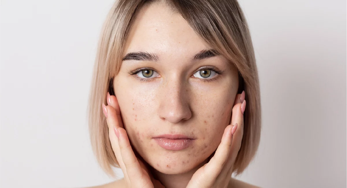 Juvelook、喬雅露、凹疤、喬雅露 效果、痘疤 、凹疤 醫美 、台北 喬雅露 、台北 凹疤 醫美 、喬雅露 副作用