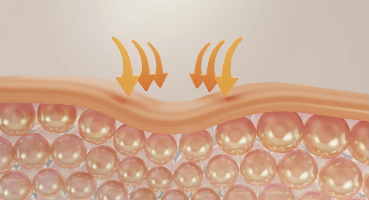 Juvelook、喬雅露、凹疤、喬雅露 效果、痘疤 、凹疤 醫美 、台北 喬雅露 、台北 凹疤 醫美 、喬雅露 副作用