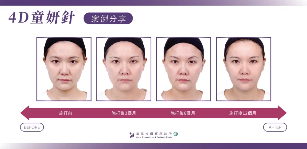 4D 童顏針案例圖