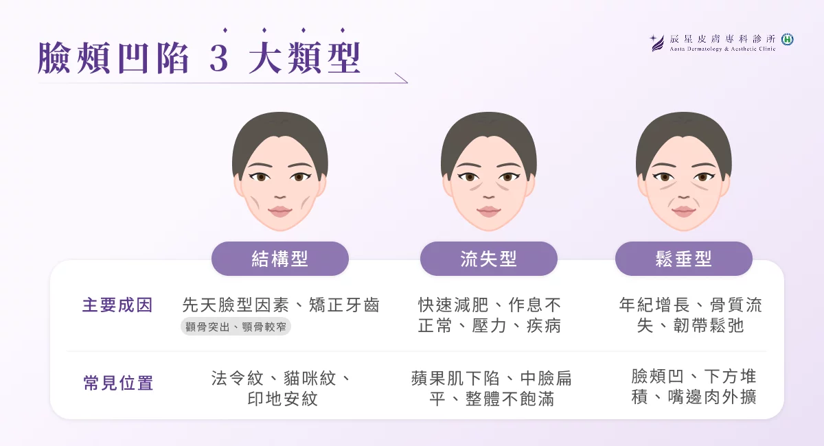  3 大臉頰凹陷類型