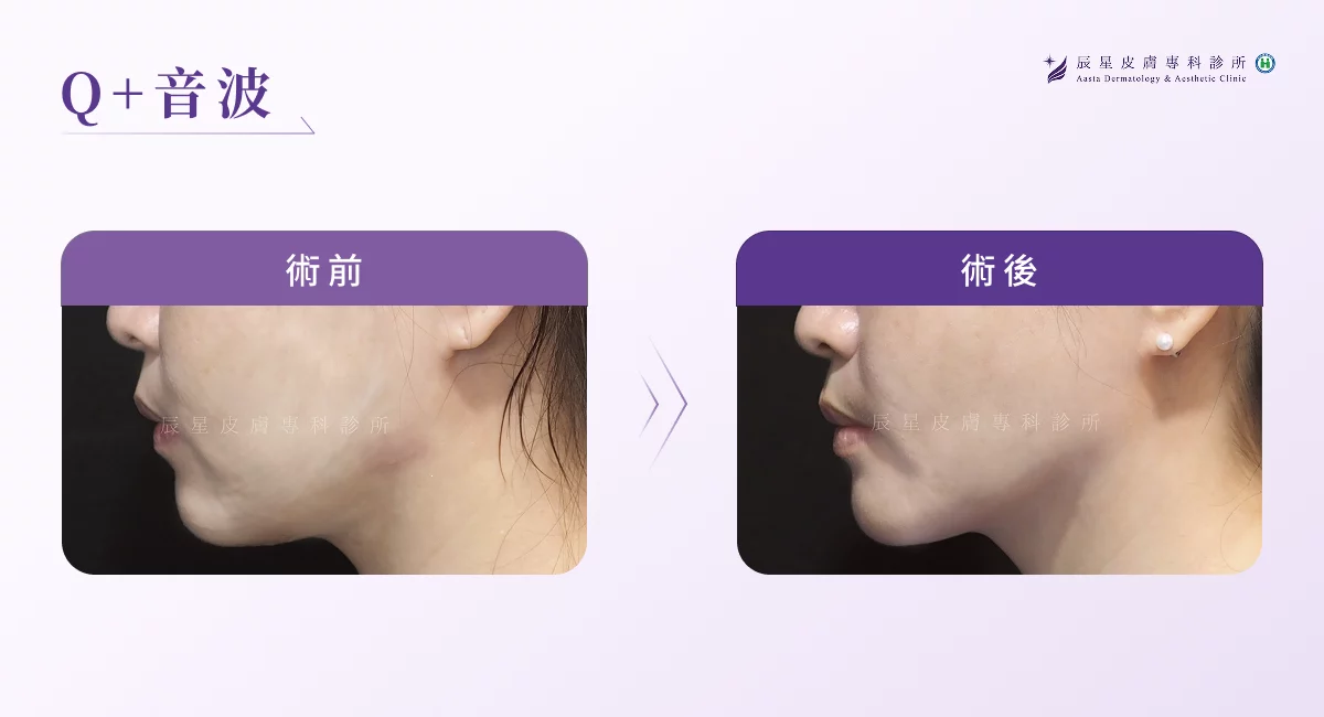 Q+ 音波案例圖