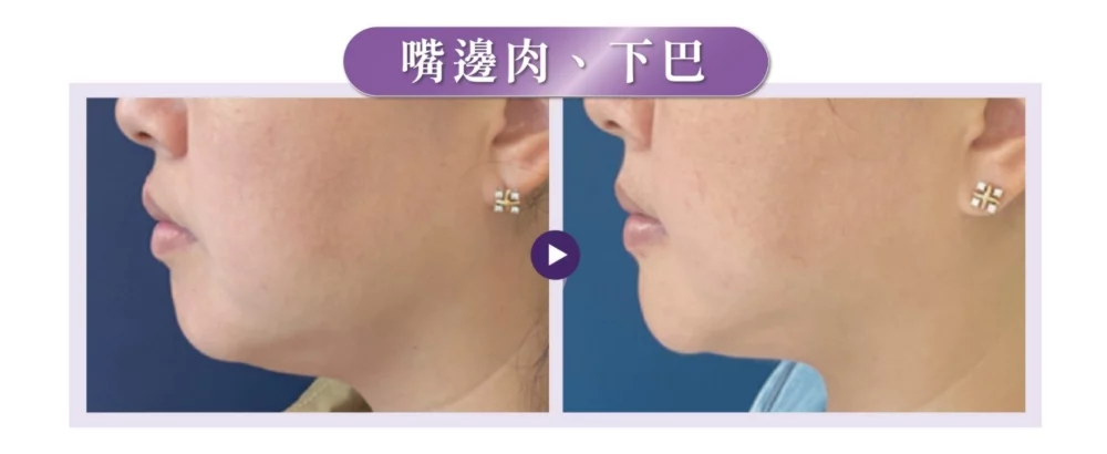 十倍電波效果案例1