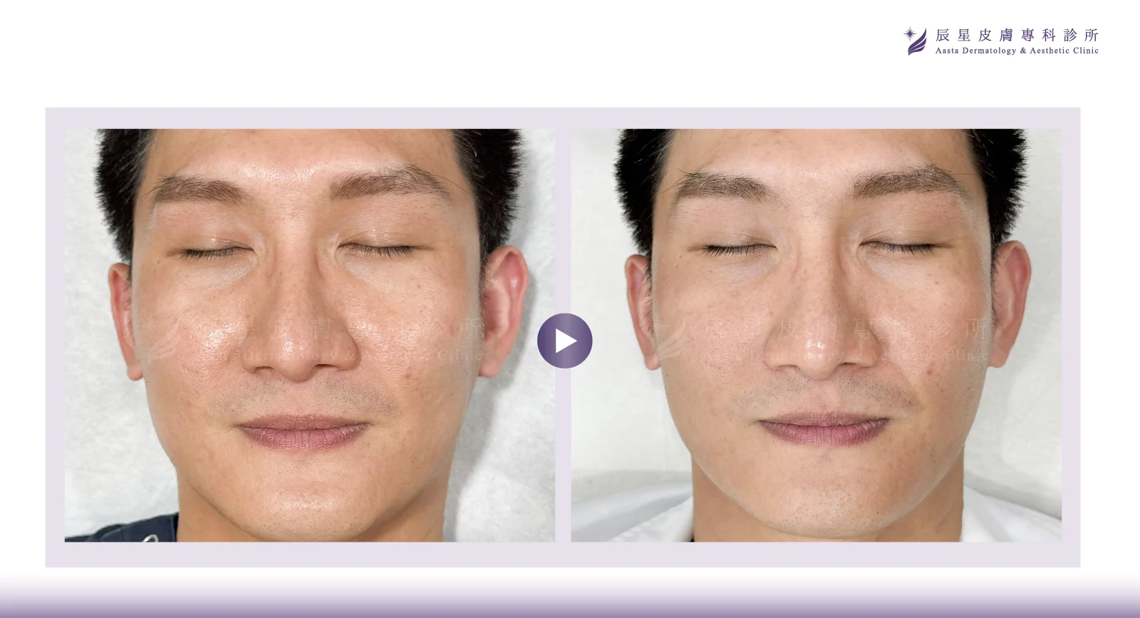 無針水光、P電漿 、超能電漿、電漿醫美、氦氣電漿 、pladuo、柏拉圖P電漿、毛孔粗大、皮脂腺、縮小毛孔、毛孔養膚