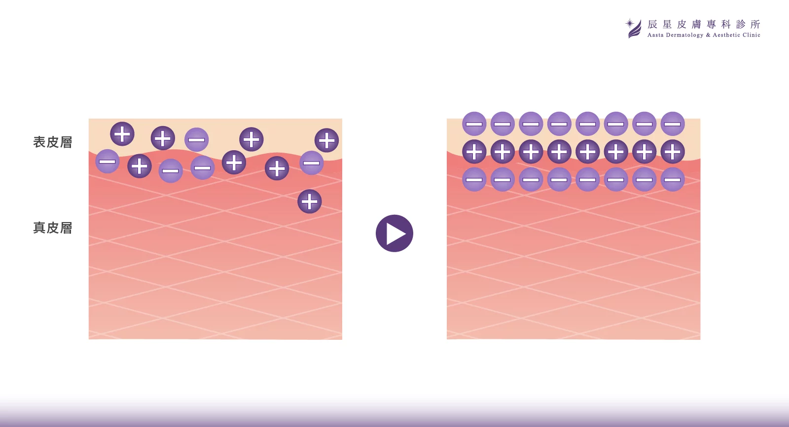無針水光、P電漿 、超能電漿、電漿醫美、氦氣電漿 、pladuo、柏拉圖P電漿、毛孔粗大、皮脂腺、縮小毛孔、毛孔養膚