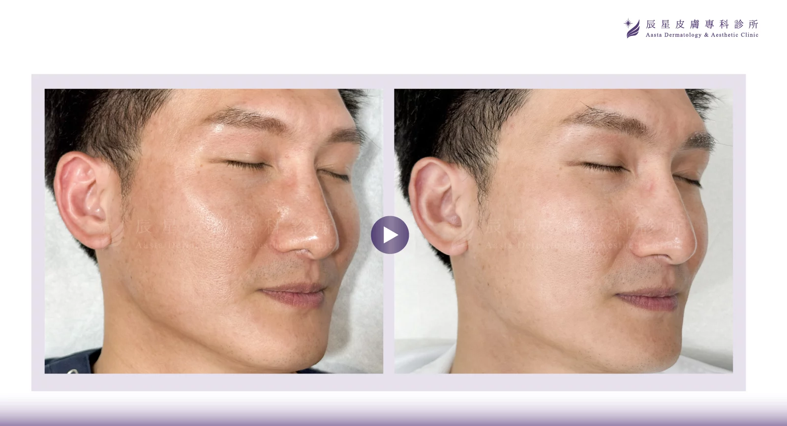 無針水光、P電漿 、超能電漿、電漿醫美、氦氣電漿 、pladuo、柏拉圖P電漿、毛孔粗大、皮脂腺、縮小毛孔、毛孔養膚