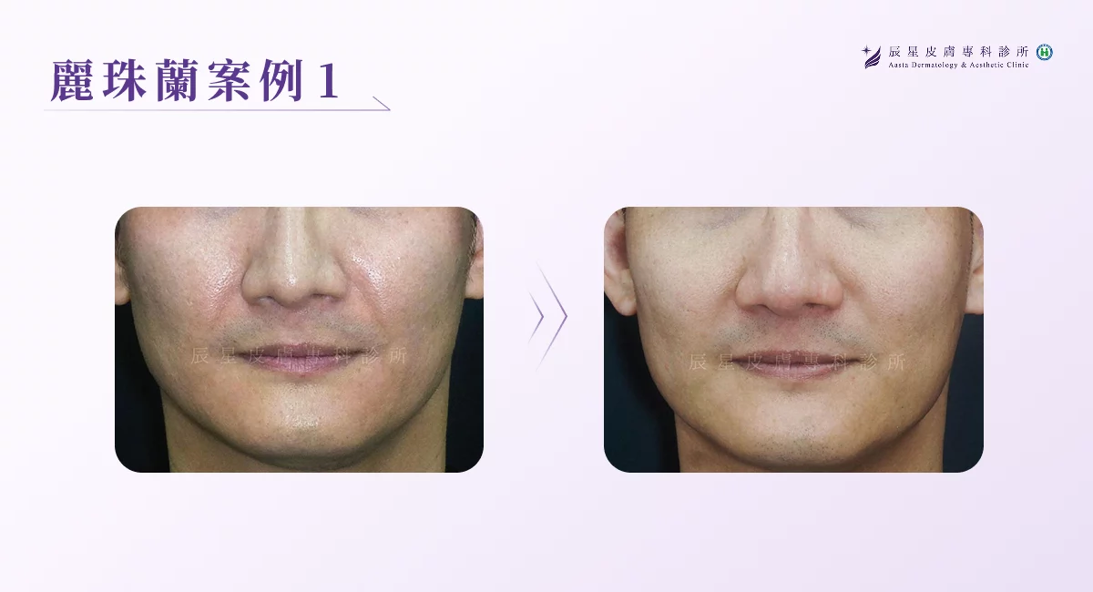 麗珠蘭案例