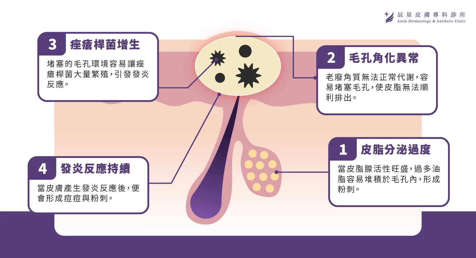 AviClear，AviClear戰鬥雷射，青春痘，成人痘，反覆長痘，皮脂腺分泌，痤瘡桿菌，痘痘，痘疤