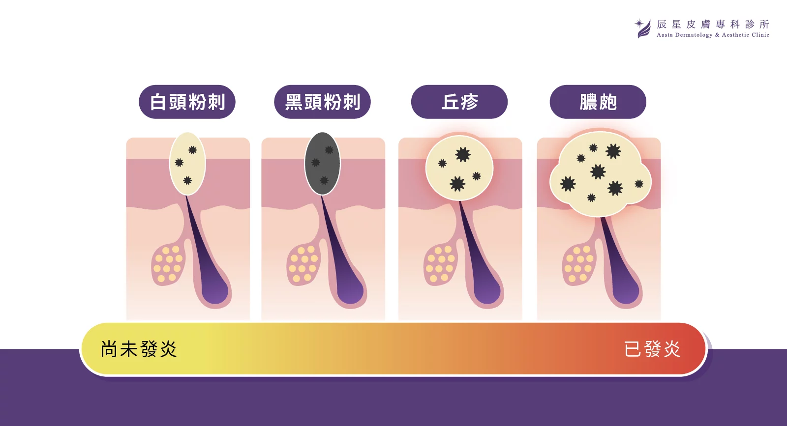 AviClear，AviClear戰鬥雷射，青春痘，成人痘，反覆長痘，皮脂腺分泌，痤瘡桿菌，痘痘，痘疤