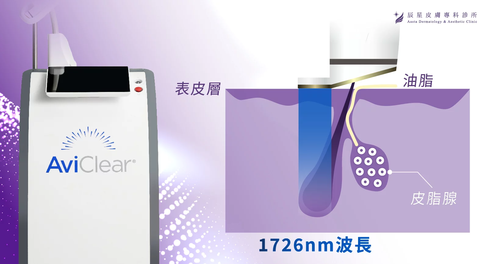 AviClear，AviClear戰鬥雷射，青春痘，成人痘，反覆長痘，皮脂腺分泌，痤瘡桿菌，痘痘，痘疤